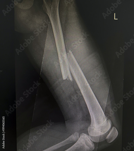 X-ray image of the broken bones of the femur 