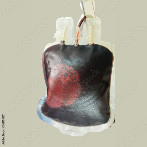A close-up shot of a blood bag with a transfusion set attached, ready for a blood transfusion procedure in a hospital or clinical environment.