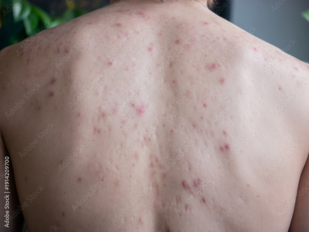 Naklejka premium Top view of a mans back with severe acne and inflamed pimples. Common skin problem and dermatology concept. Medical treatment and skincare needs.