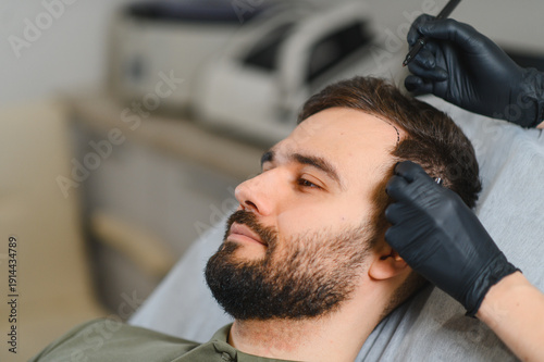 Fotografía Man undergoing hair transplant procedure marking receding hairline