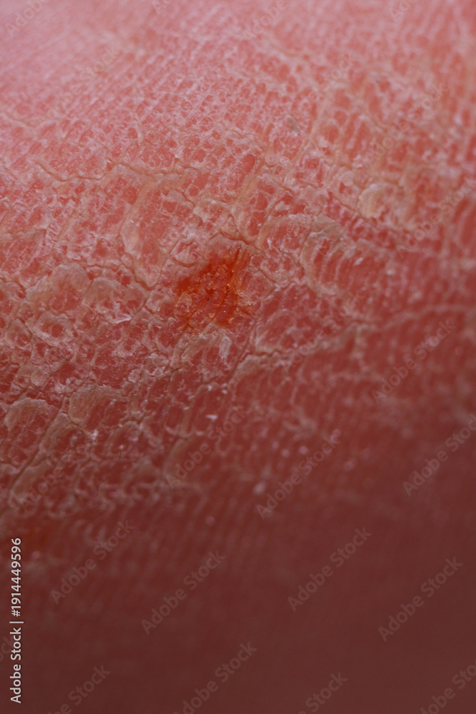 Fototapeta premium Extreme dryness of feet skin texture