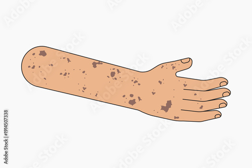 Vitiligo arm hand, body part flat collage element vector