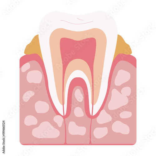 Tooth Decay Stages Illustration