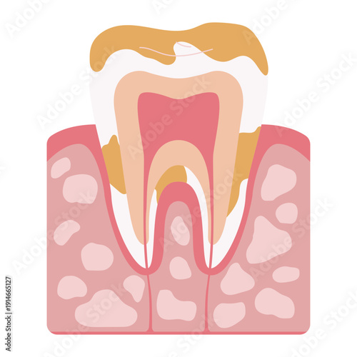 Tooth Decay Stages Illustration
