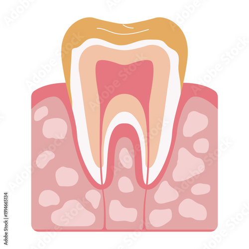 Tooth Decay Stages Illustration
