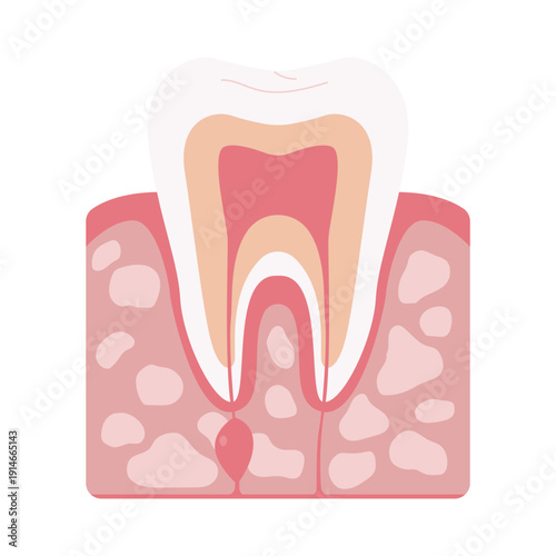 Tooth Decay Stages Illustration
