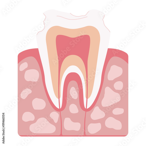Tooth Decay Stages Illustration