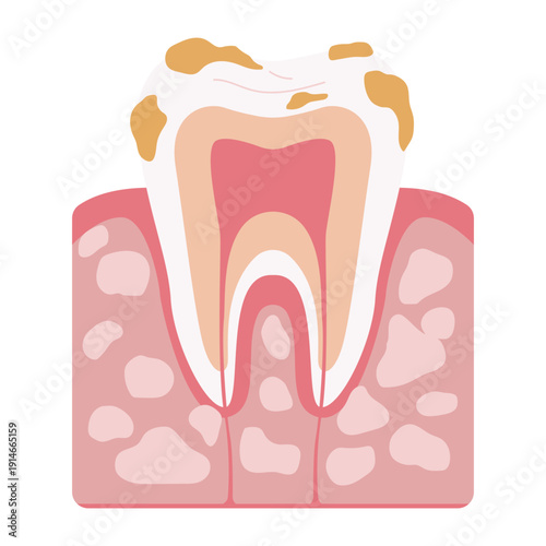 Tooth Decay Stages Illustration