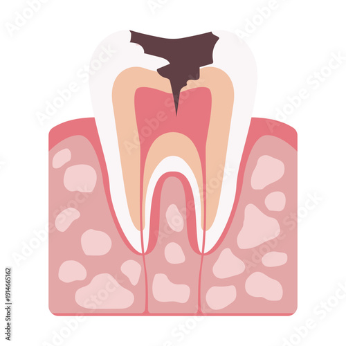 Tooth Decay Stages Illustration