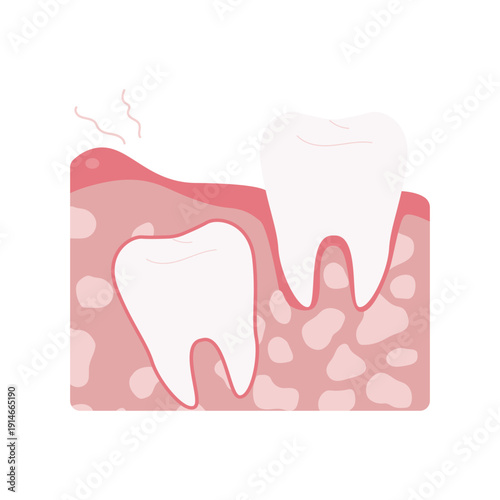 Tooth Decay Stages Illustration