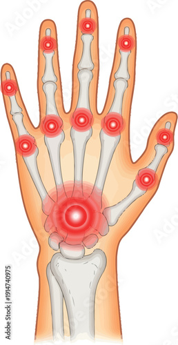 “Medical Illustration: Hand Pain Diagram, Arthritis Inflammation and Skeletal Anatomy 