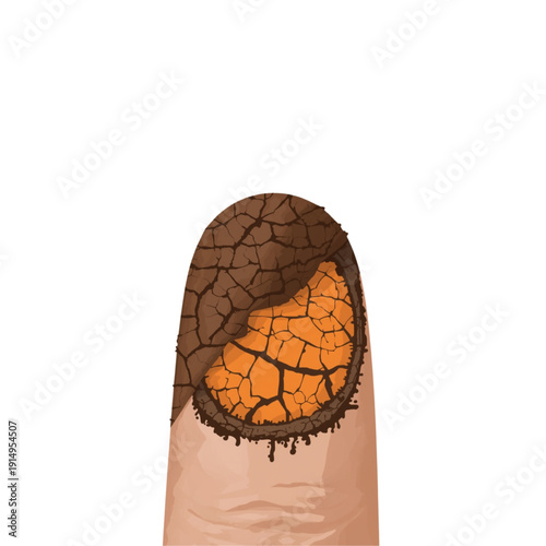 Dry cracked finger with peeling skin illustration