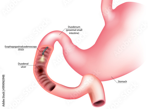 Esophagogastroduodenoscopy EGD Procedure Showing Duodenal Ulcer Medical Illustration. Upper Endoscopy Examination of Duodenum with Peptic Ulcer Diagram