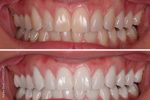 Before and after teeth whitening comparison, upper and lower jaw close-up dental photo