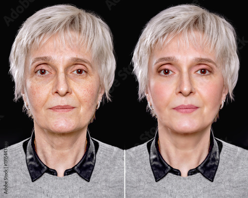 Cuadro en lienzo Cosmetic skin rejuvenation procedures for couperose and skin laxity, before and