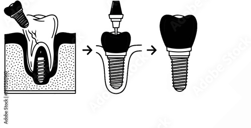 Diagram illustrates dental implant placement sequence, showing tooth structure and bone