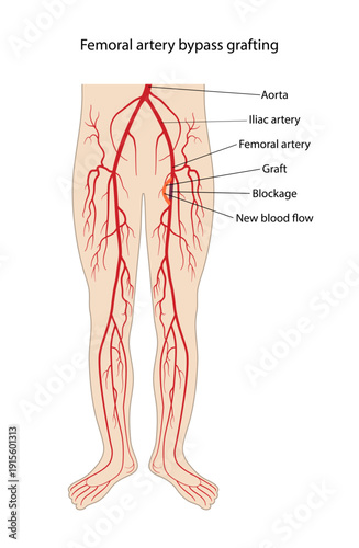 Medical illustration of the lower extremities with femoral artery bypass grafting. Vector illustration in a flat style on a white background.