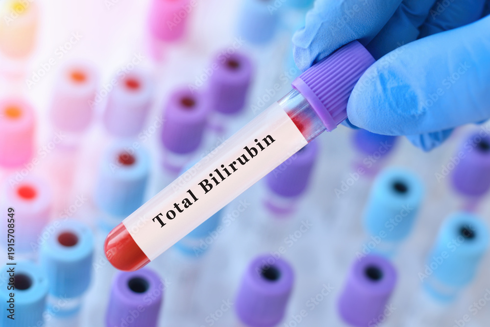 Obraz premium Doctor holding a test blood sample tube with Total Bilirubin test on the background of medical test tubes with analyzes.
