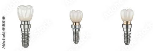 Dental implant isolated on white background, titanium implant screw close up, realistic implant dentistry component for tooth replacement, oral surgery prosthodontics equipment, dental clinic medical 