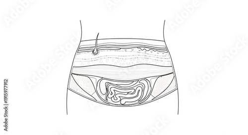 Anatomical illustration of the human abdomen showing layers of skin, muscle, and intestines.