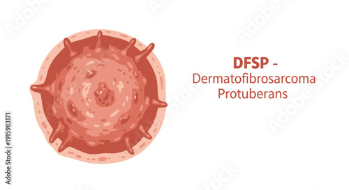 Dermatofibrosarcoma Protuberans (DFSP) skin cancer medical illustration.