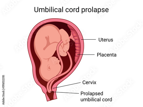 Prolapsed umbilical cord during childbirth. Obstetric complication in which the umbilical cord fall below the presenting part of the fetus. Medical vector illustration
