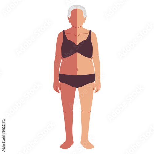 human stroke paralysis types medical Illustrations