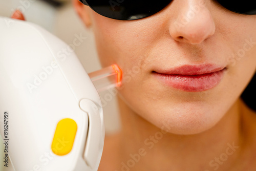 Fotografía Quick rosacea treatment by high quality laser devices.