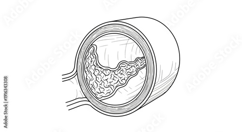 Cross Section of Artery with Atherosclerosis and Plaque Buildup