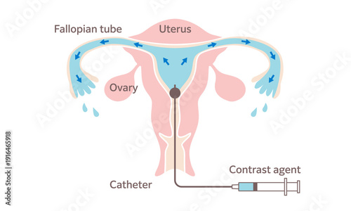 Hysterosalpingography Medical Illustration