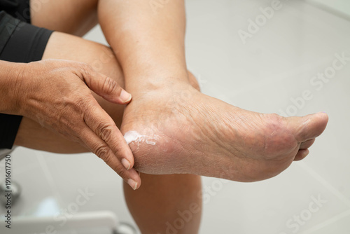 Asian woman check feet with crack and dry heel skin, Diabetic Foot.