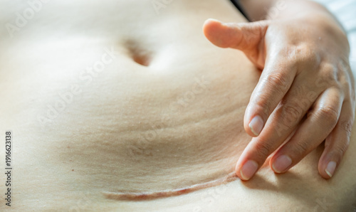Fotografía Close-up of a healed C-section scar on a woman's belly with a hand gently touching the skin