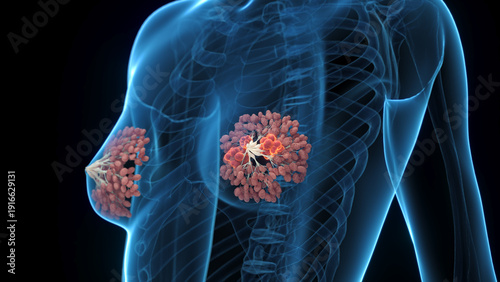 Detailed 3D Render Of Breast Cancer In A Human Female Shown In Full Anatomical View