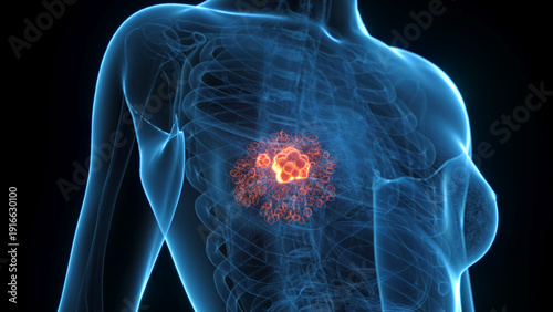Comprehensive Anatomical Render Of Breast Cancer In A Human Female
