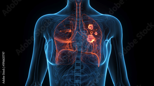 A Detailed 3D Depiction Of Lung Cancer In A Human Female