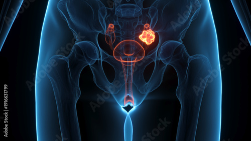 A Detailed 3D Depiction Of Ovarian Cancer In A Woman