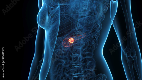 Bild auf Leinwand A Detailed 3D Depiction Of Pancreatic Cancer In A Woman