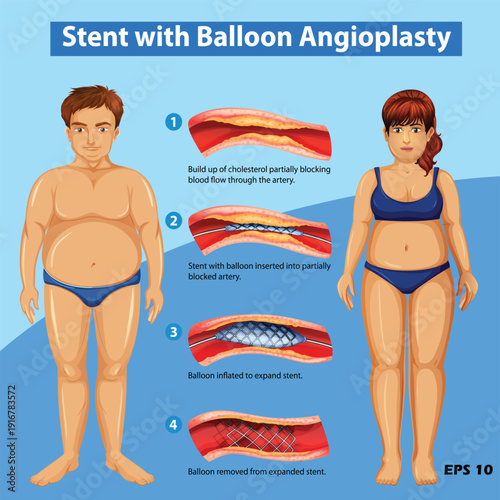 Stent with Balloon Angioplasty Medical Illustration. 4-Step Vector Diagram showing Cholesterol Buildup, Stent Insertion, and Balloon Inflation in Artery