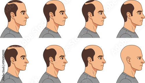 Male balding progression hair loss stages