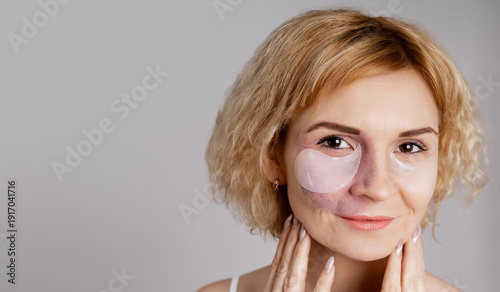 Slika na platnu Woman with visible port-wine stain birthmark vascular skin condition wearing  hy