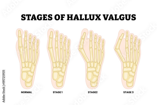 Stages of hallux valgus stages. Bony bump bunion phase structure. Bony deformity of the big toe. Feet bone. Medical science education illustration vector.