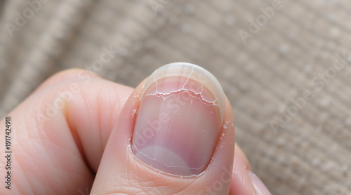 Macro close-up of brittle and cracked fingernail. Damaged nail plate texture showing health problem. Dermatology concept