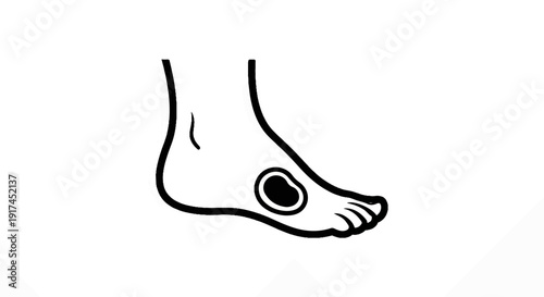A simplified line drawing of a human foot with a dark spot on the sole