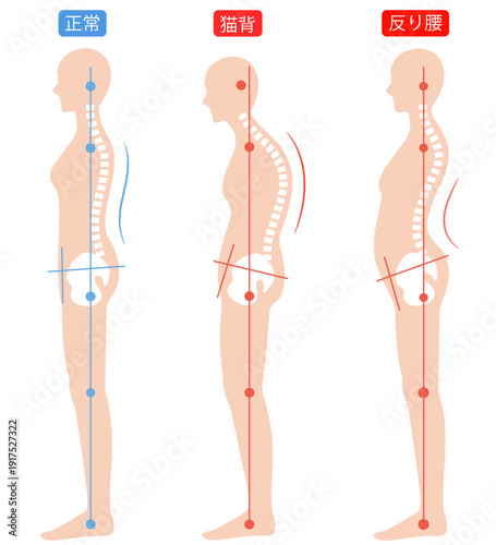 正しい姿勢と猫背と反り腰の女性　背骨と骨盤