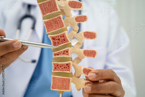 Tableau sur toile Doctor holding osteoporosis in back bone model for treatment medical in orthopedic department