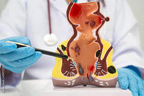 Schilderij op canvas Asian doctor with rectum and hemorrhoid human anatomy model at hospital, inflamed vascular structure