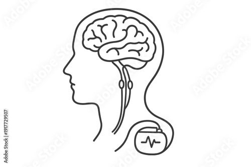 A minimalist line art illustration of a human head in profile showing the brain and a medical implant device with wires connected to the nervous system for deep brain stimulation.