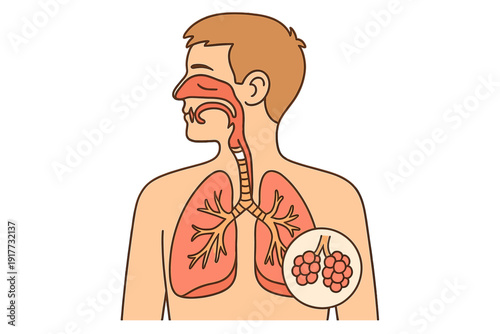 This medical illustration depicts the human respiratory system including the nose, throat, trachea, and lungs. A circular inset shows a close-up view of the alveoli clusters.