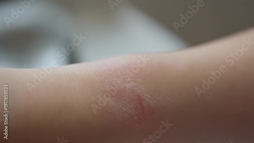 Extreme close up slow motion macro view showing a patch of irritated dry skin with redness and scaling on a child's smooth pale arm, illustrating common dermatological
