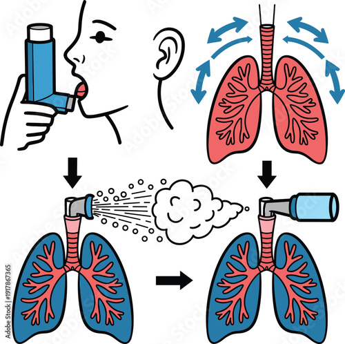 Asthma Inhaler Usage Diagram with Human Lungs and Respiratory System Illustration Showing Proper Breathing Technique, Airflow Process and Medication Spray for Healthcare Education